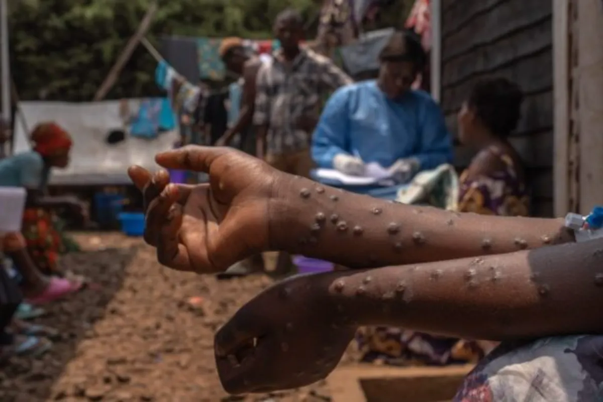 Mpox: Moçambique regista mais 1 caso positivo em Tete e 12 recuperados em Niassa